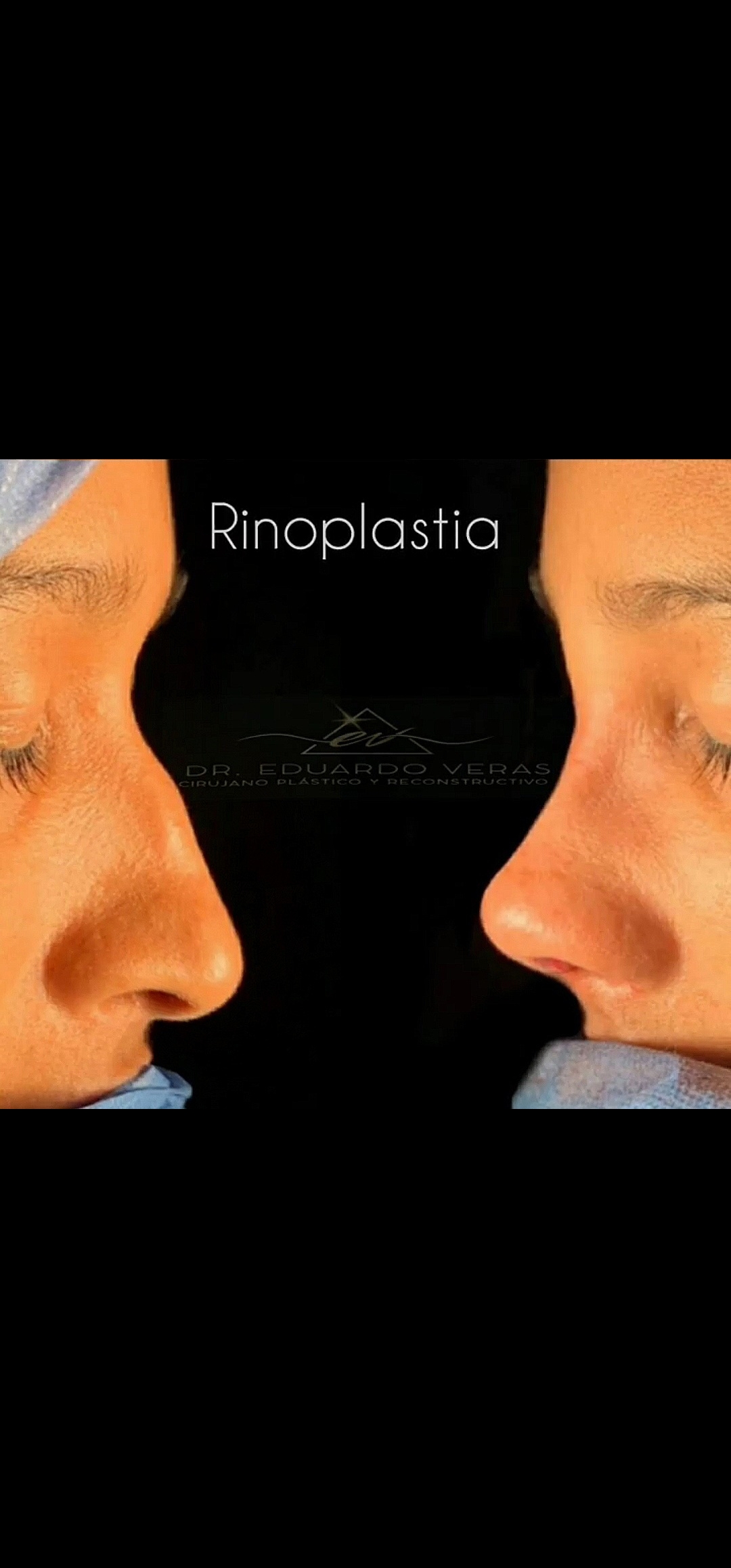 Antes y después rinoplastia