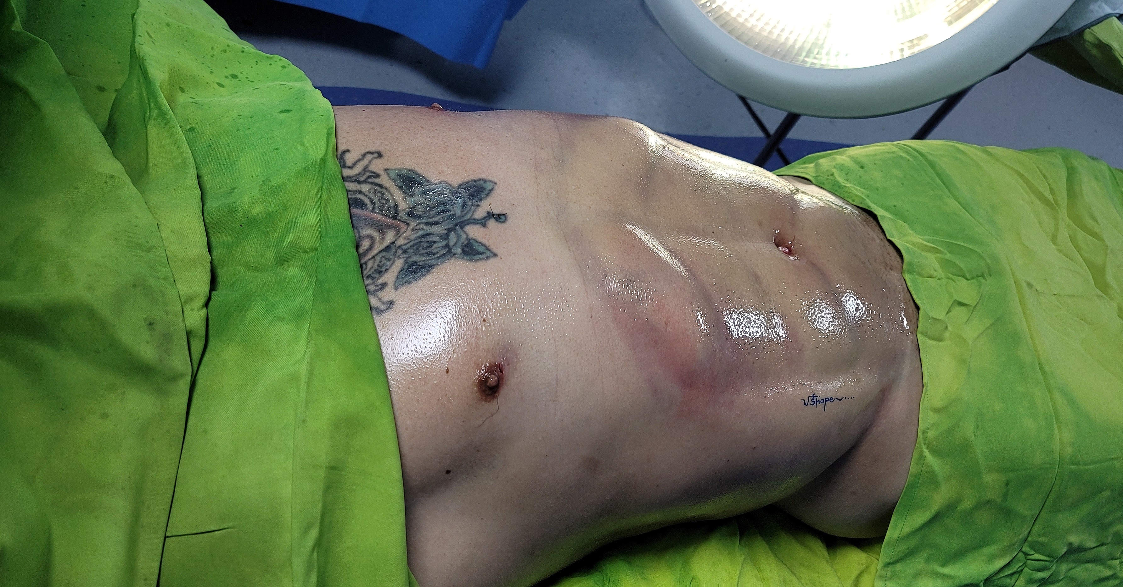 Resultado Spartan Body / contorno abdominal